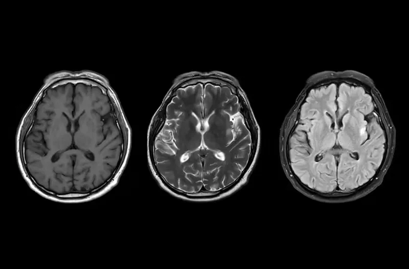 Metabolic syndrome that one in four adults has may be ageing their brains 1 MRI Scans of brain