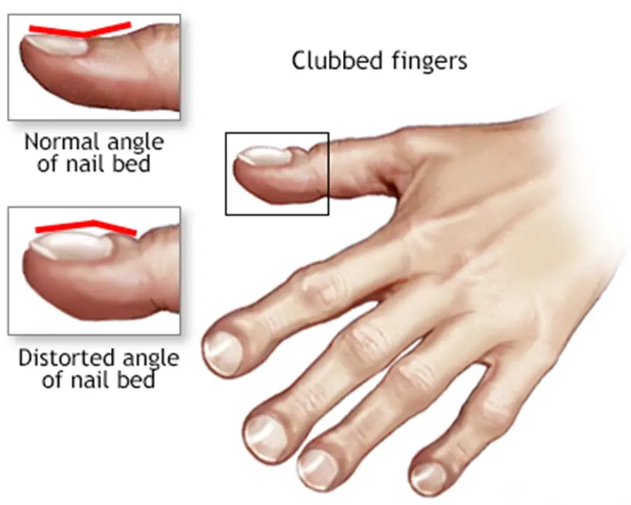 Signs on your skin may be an indicator of heart disease: Dermatologist 2 nail clubbing