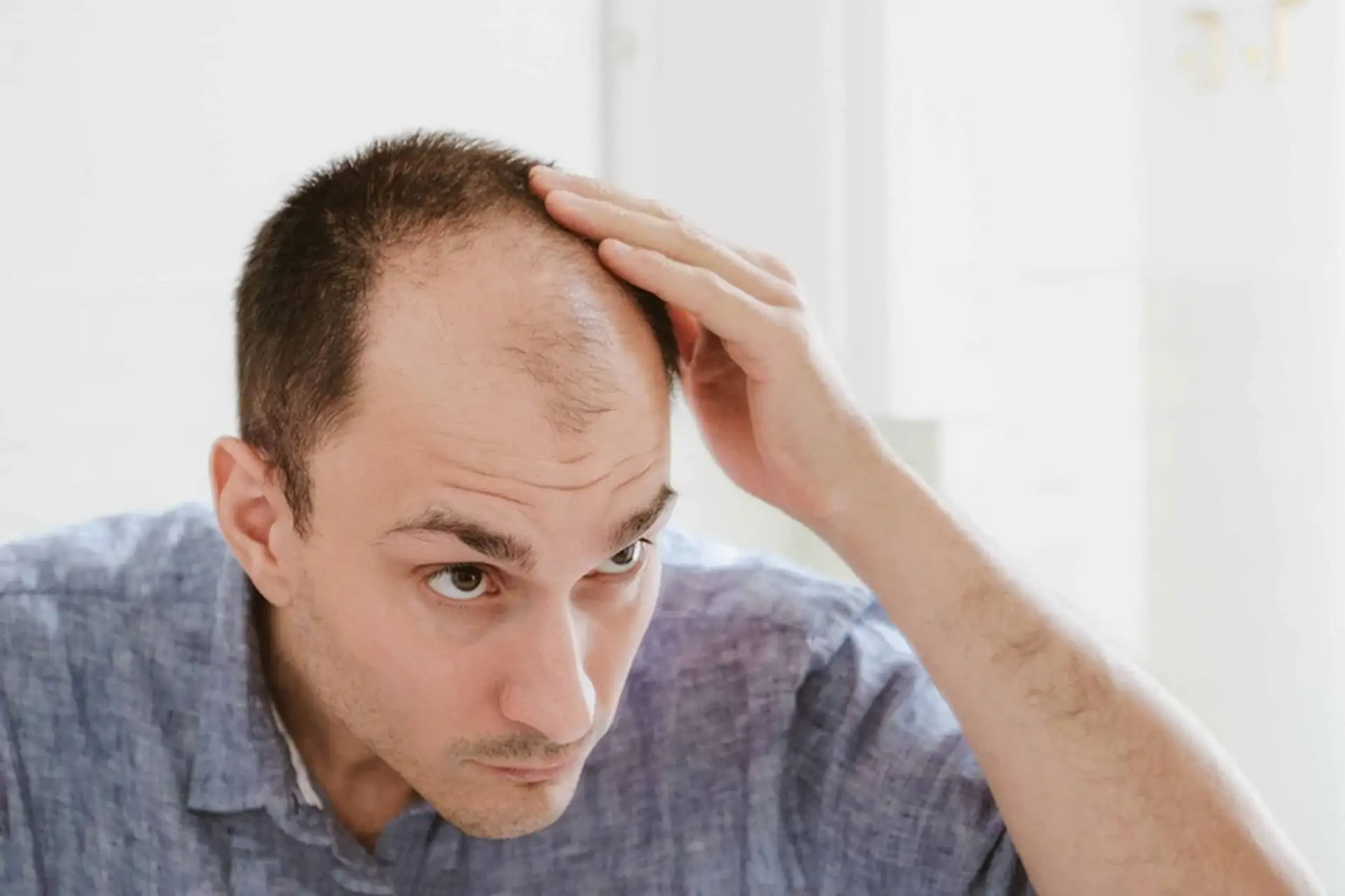 What your hair can tell you about your health 1 baldness