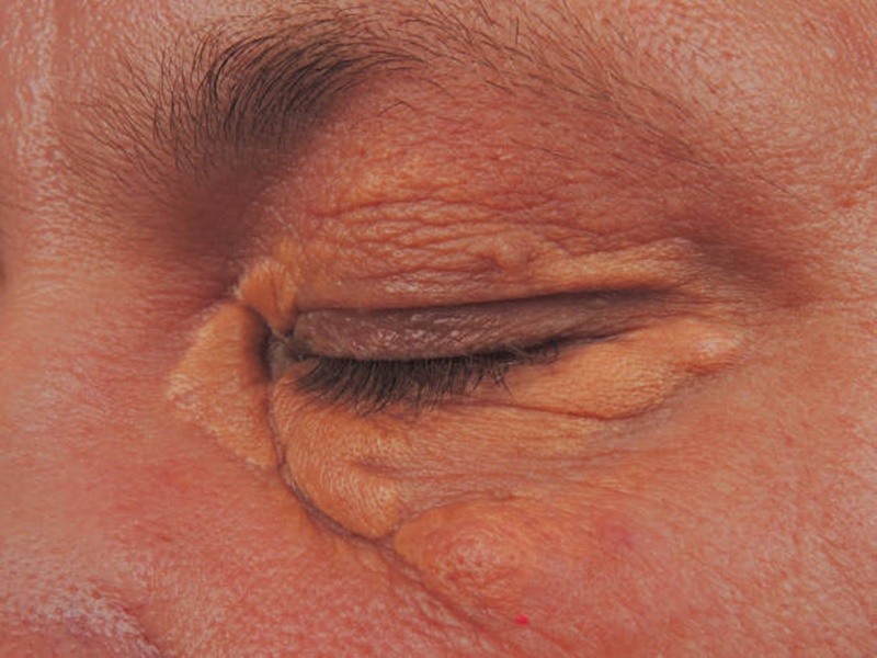 Two warning signs high cholesterolon your face you should never ignore 1 Xanthelasma Patch