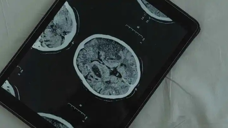 AI brain scan tool predicts how fast you are aging 3 fast aging