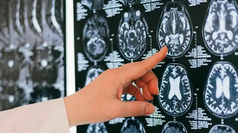 AI brain scan tool predicts how fast you are aging 1 fast you are aging