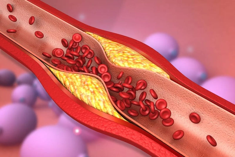 Slash cholesterol and blood pressure with coriander seeds 2 high cholesterol